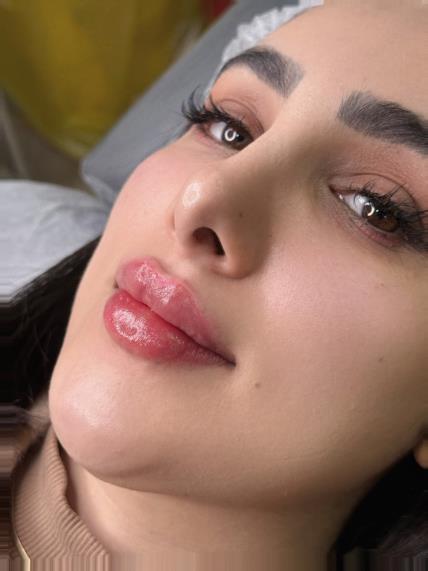 بهترین برند فیلر لب در مشهد | مقایسه ژوویدرم، رستیلن و تئوسیال