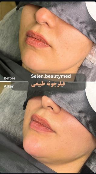 دکتر متخصص تزریق ژل و فیلر در مشهد | راهنمای انتخاب پزشک و هزینه